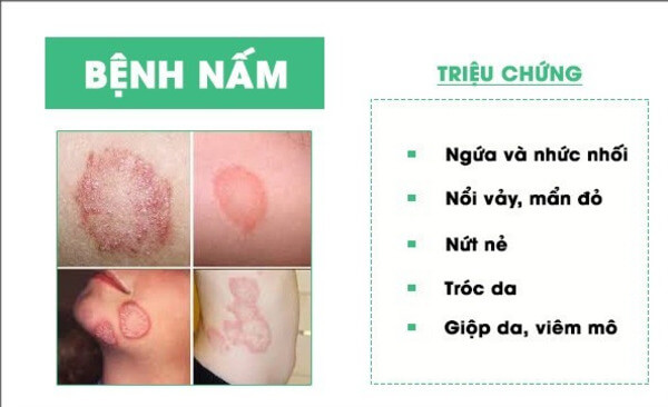 Bệnh nấm