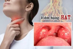 Những cách chữa viêm họng hạt dân gian hiệu quả