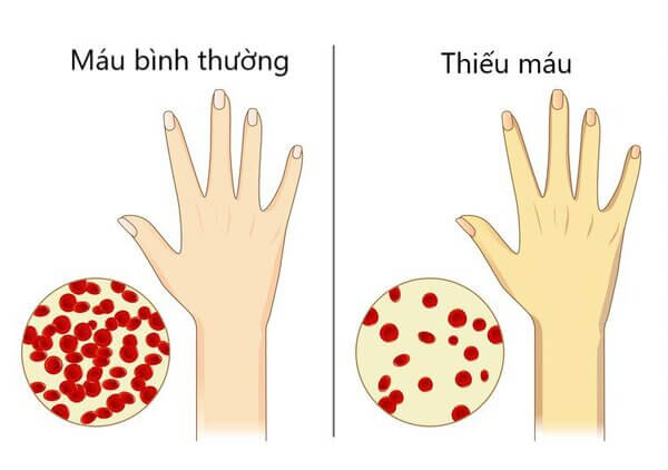 Một số triệu chứng thiếu máu khi mang thai