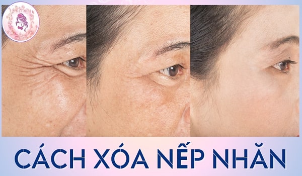 Cách xóa nếp nhăn phổ biến nhất